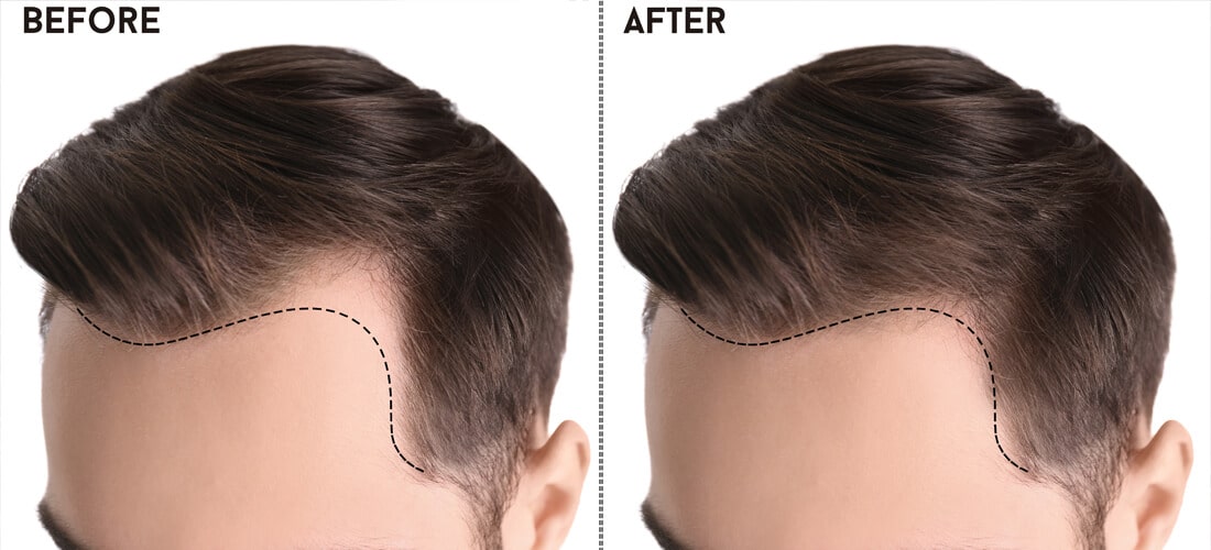 Best Hair Transplant in Pakistan