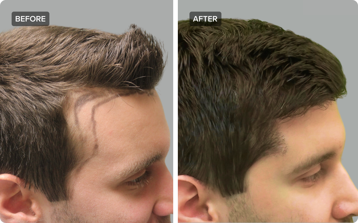 Best Hair Transplant in Pakistan