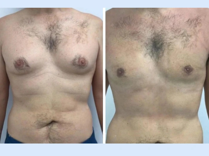 Gynecomastia in dubaiGynecomastia in dubai